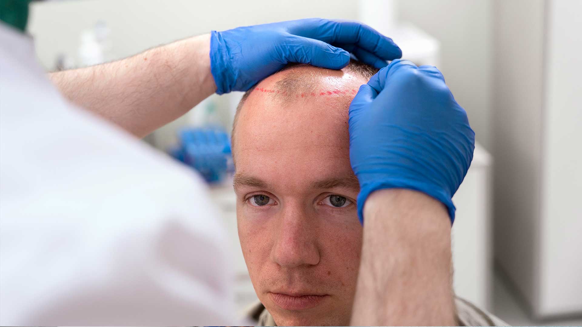 Hair Transplant Turkey