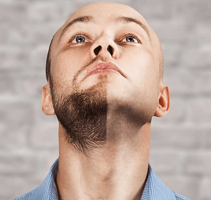 Beard Transplant